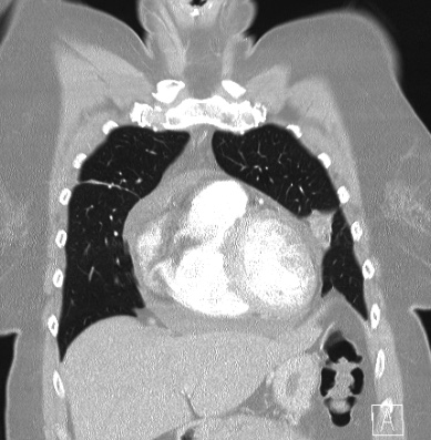 Cardiac sarcoidosis (Radiopaedia 74548-85534 Coronal lung window 16).jpg