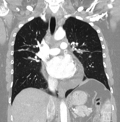 Cardiac sarcoidosis (Radiopaedia 74548-85534 Coronal lung window 33).jpg