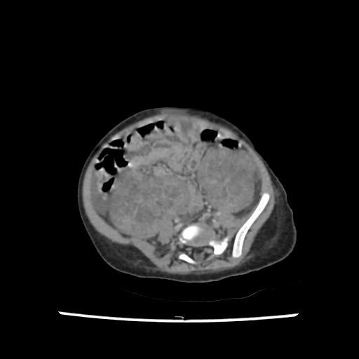 Caroli disease with autosomal recessive polycystic kidney disease (ARPKD) (Radiopaedia 89651-106703 B 164).jpg