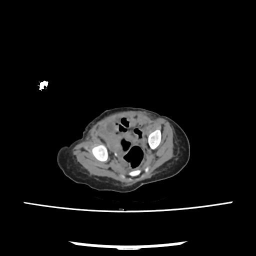 Caroli disease with autosomal recessive polycystic kidney disease (ARPKD) (Radiopaedia 89651-106703 E 209).jpg