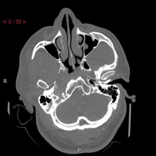 Caroticocavernous fistula (Radiopaedia 42346-45457 A 11).jpg