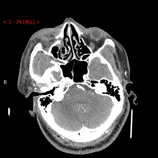 Caroticocavernous fistula (Radiopaedia 42346-45457 B 5).jpg
