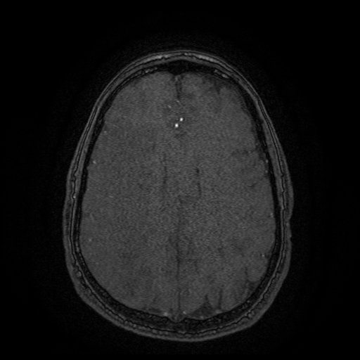Carotid arterial dissection with acute cerebral infarction (Radiopaedia 26636-26784 MRA 42).jpg