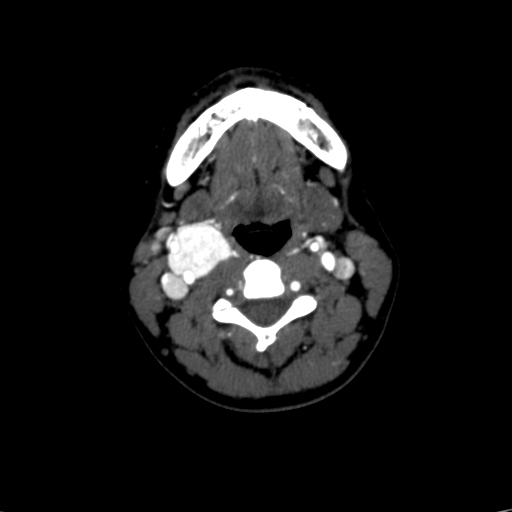 Carotid body tumor (Radiopaedia 39845-42300 B 36).jpg