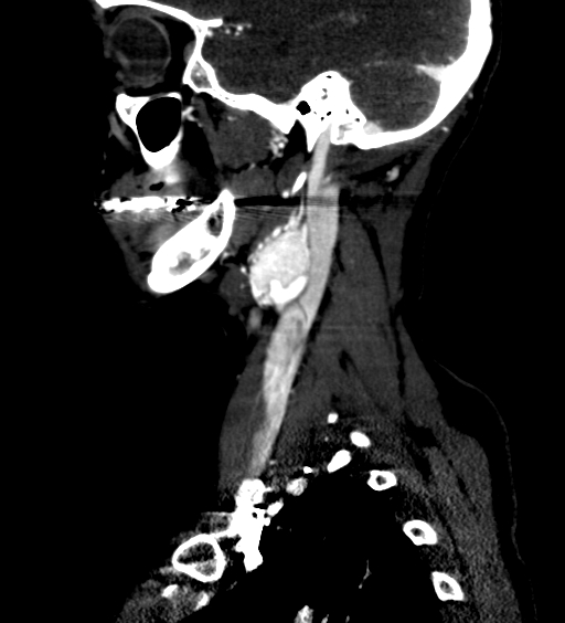File:Carotid body tumor (Radiopaedia 39845-42300 D 15).jpg