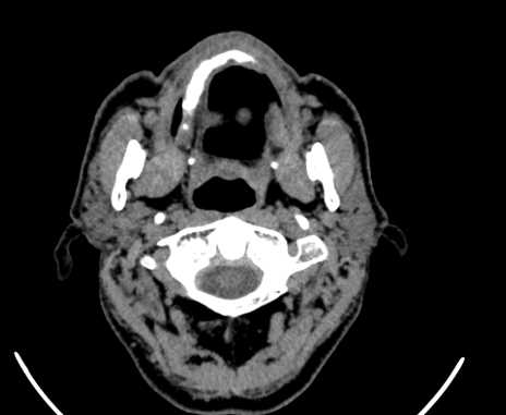 File:Carotid body tumor (Radiopaedia 61750-69757 Axial non-contrast 13).jpg
