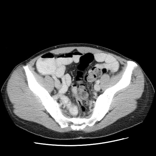 Castleman disease with fibrous pseudotumor in the abdomen (Radiopaedia 77296-89373 A 100).jpg