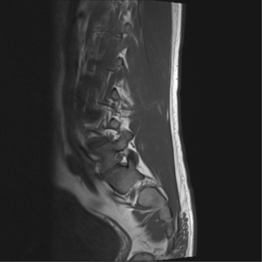 File:Cauda equina syndrome (Radiopaedia 53615-59672 Axial T1 14).png
