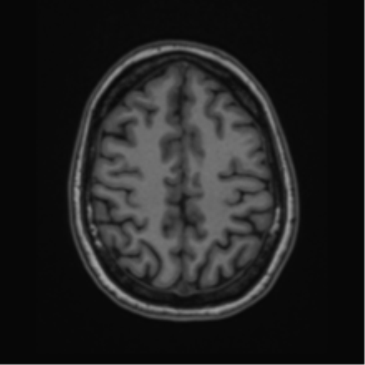 Cavernoma with bleed - midbrain (Radiopaedia 54546-60774 Axial T1 42).png