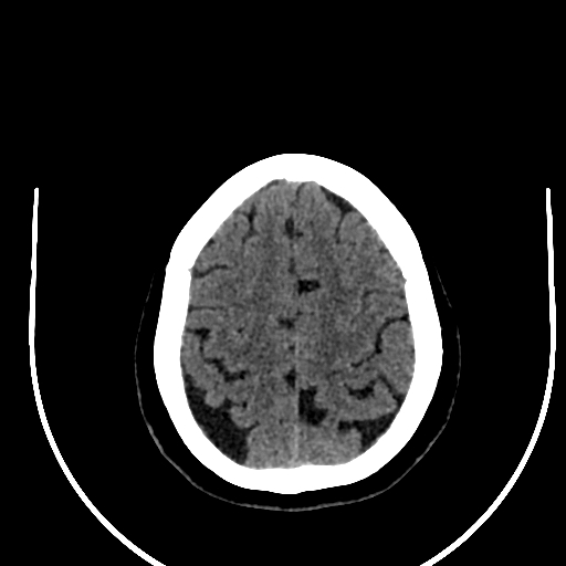 Cavernous hemangioma of the cerebellar falx (Radiopaedia 73025-83723 Axial non-contrast 110).jpg