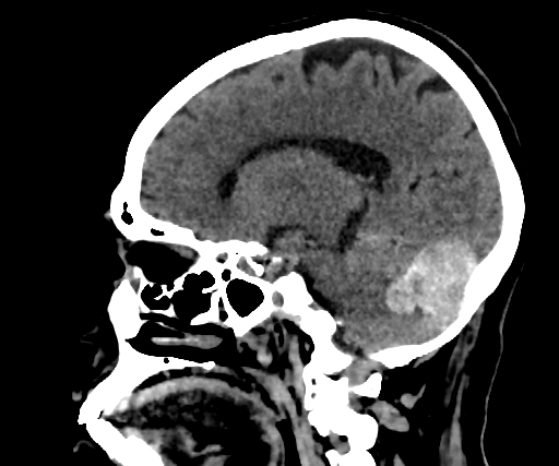 Cavernous hemangioma of the cerebellar falx (Radiopaedia 73025-83723 B 132).jpg