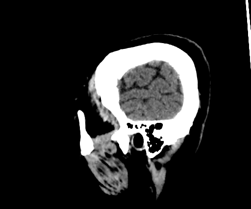 Cavernous hemangioma of the cerebellar falx (Radiopaedia 73025-83723 B 41).jpg