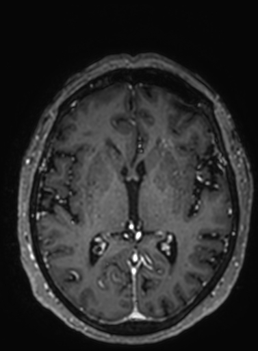 Cavernous hemangioma of the cerebellar falx (Radiopaedia 73025-83724 Axial T1 C+ 165).jpg