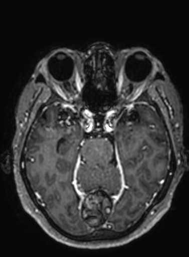 File:Cavernous hemangioma of the cerebellar falx (Radiopaedia 73025-83724 Axial T1 C+ 216).jpg