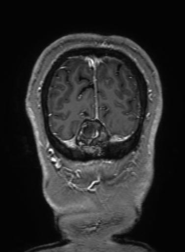 Cavernous hemangioma of the cerebellar falx (Radiopaedia 73025-83724 Coronal T1 C+ 340).jpg