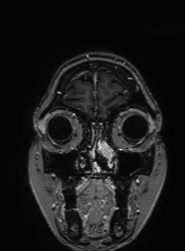 Cavernous hemangioma of the cerebellar falx (Radiopaedia 73025-83724 Coronal T1 C+ 45).jpg