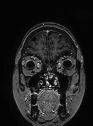 Cavernous hemangioma of the cerebellar falx (Radiopaedia 73025-83724 Coronal T1 C+ 61).jpg