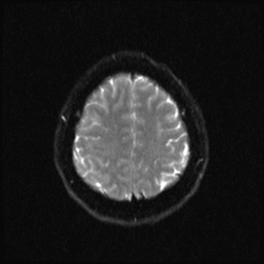 File:Cavernous sinus meningioma (Radiopaedia 63682-72367 DWI 18).jpg