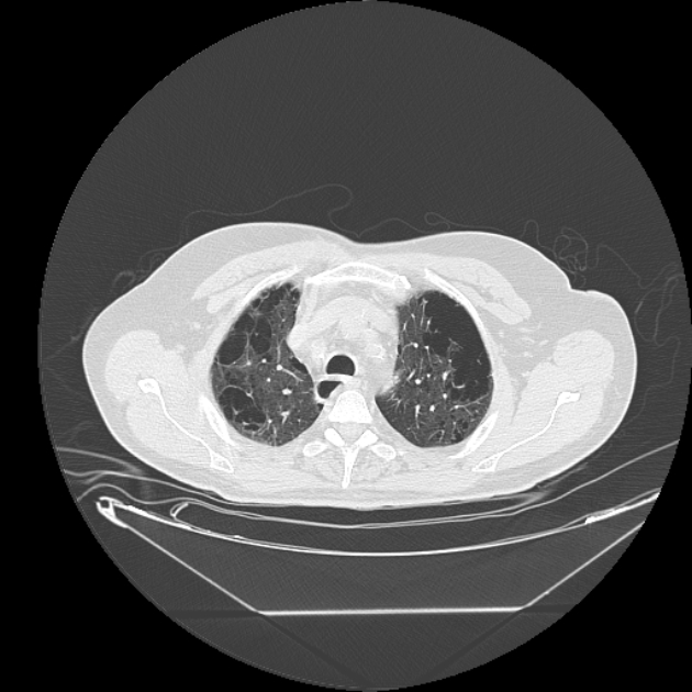 Cavitating bronchogenic carcinoma (Radiopaedia 44489-48162 Axial lung window 14).jpg