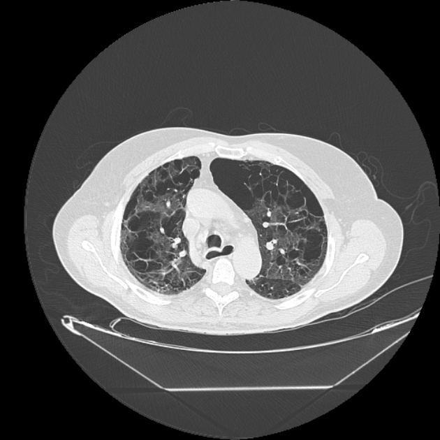 Cavitating bronchogenic carcinoma (Radiopaedia 44489-48162 Axial lung window 27).jpg