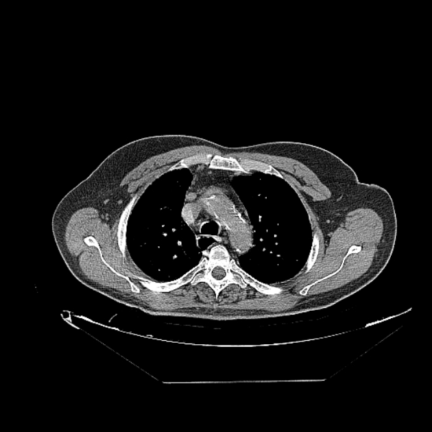 Cavitating bronchogenic carcinoma (Radiopaedia 44489-48162 Axial non-contrast 18).jpg