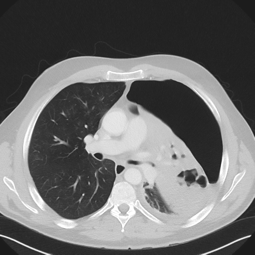 File:Cavitating pneumonia complicated by pneumothorax (Radiopaedia 48149-52994 Axial lung window 32).png