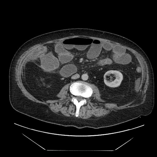 Cecal adenocarcinoma (Radiopaedia 64871-73817 A 51).jpg