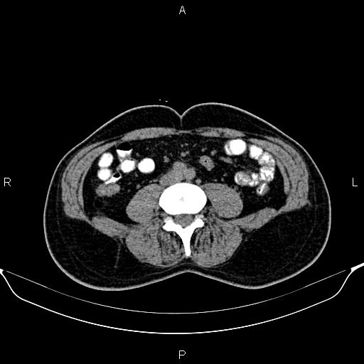 Cecal adenocarcinoma (Radiopaedia 85324-100916 Axial non-contrast 58).jpg
