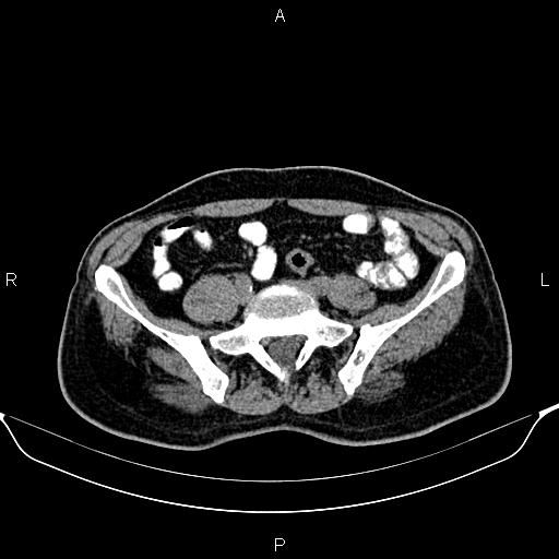 File:Cecal adenocarcinoma (Radiopaedia 85324-100916 Axial non-contrast 68).jpg