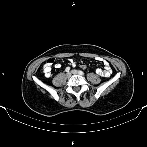 Cecal adenocarcinoma (Radiopaedia 85324-100916 B 64).jpg