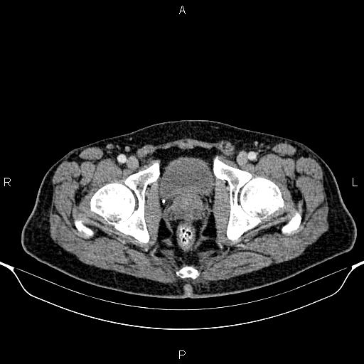 Cecal adenocarcinoma (Radiopaedia 85324-100916 B 97).jpg