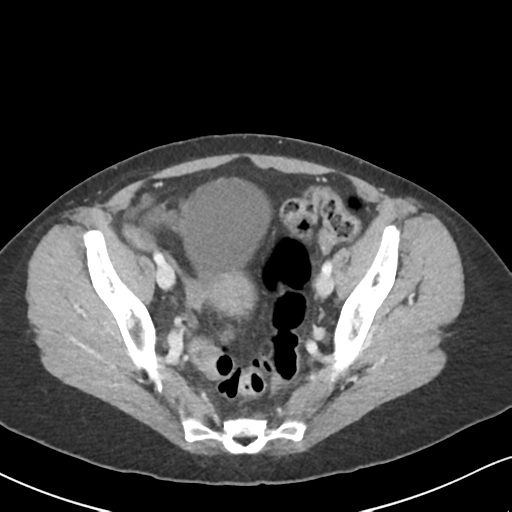 Cecal internal hernia through the foramen of Winslow (Radiopaedia 44820-48651 B 63).png