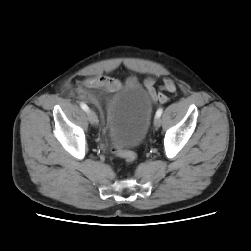 Cecal mass causing appendicitis (Radiopaedia 59207-66531 A 75).jpg
