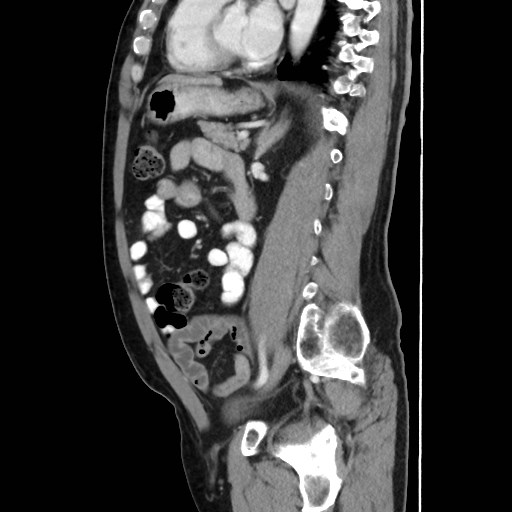 Cecal mass causing appendicitis (Radiopaedia 59207-66531 C 40).jpg