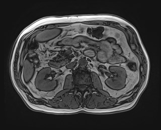 Cecal mass causing appendicitis (Radiopaedia 59207-66532 D 59).jpg
