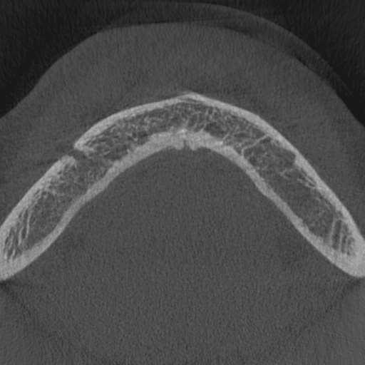 Cemento-osseous dysplasia (Radiopaedia 48251-53126 Axial non-contrast 4).jpg