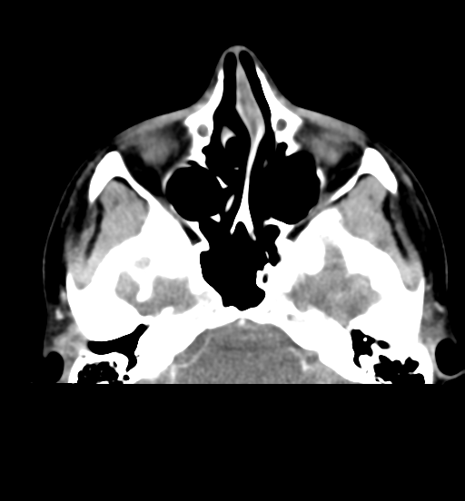 File:Cemento-ossifying fibroma (Radiopaedia 46243-50643 Axial C+ delayed 20).png