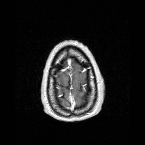 Central-variant posterior reversible encephalopathy syndrome (PRES) (Radiopaedia 43880-47358 Axial T1 C+ 159).jpg
