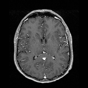 Central-variant posterior reversible encephalopathy syndrome (PRES) (Radiopaedia 43880-47358 Axial T1 C+ 87).jpg