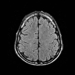 File:Central-variant posterior reversible encephalopathy syndrome (PRES) (Radiopaedia 43880-47359 Axial FLAIR 18).jpg
