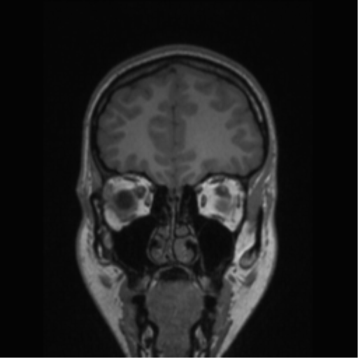 Central neurocytoma (Radiopaedia 37664-39557 Coronal T1 73).png