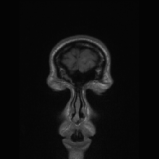Central neurocytoma (Radiopaedia 37664-39557 Coronal T1 85).png