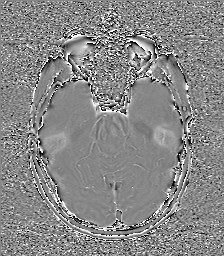 Central neurocytoma (Radiopaedia 84497-99872 Axial 24).jpg