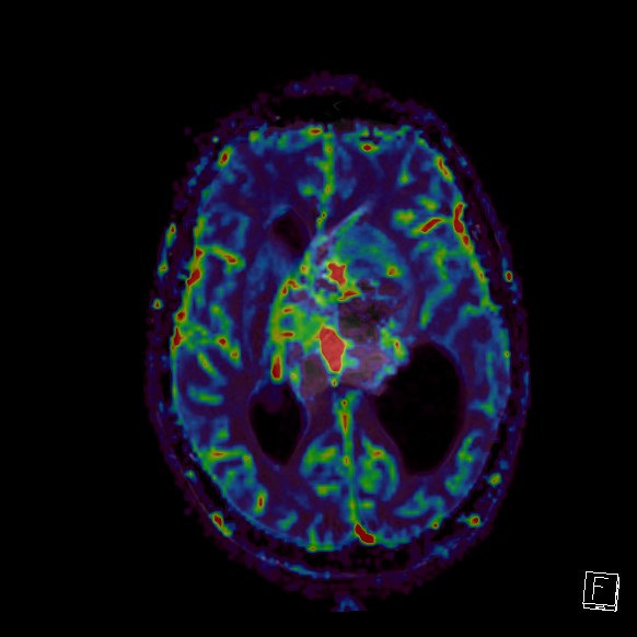 Central neurocytoma (Radiopaedia 84497-99872 Axial Perfusion 158).jpg