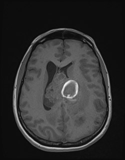 Central neurocytoma (Radiopaedia 84497-99872 Axial T1 124).jpg