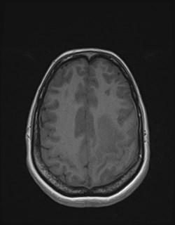 Central neurocytoma (Radiopaedia 84497-99872 Axial T1 148).jpg