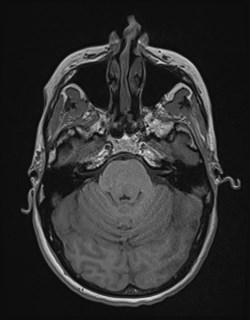 Central neurocytoma (Radiopaedia 84497-99872 Axial T1 62).jpg