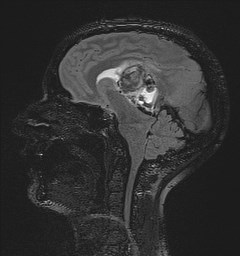 Central neurocytoma (Radiopaedia 84497-99872 Sagittal Flair + Gd 83).jpg