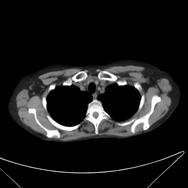 Centrilobular pulmonary emphysema (Radiopaedia 24495-24789 Axial non-contrast 6).jpg