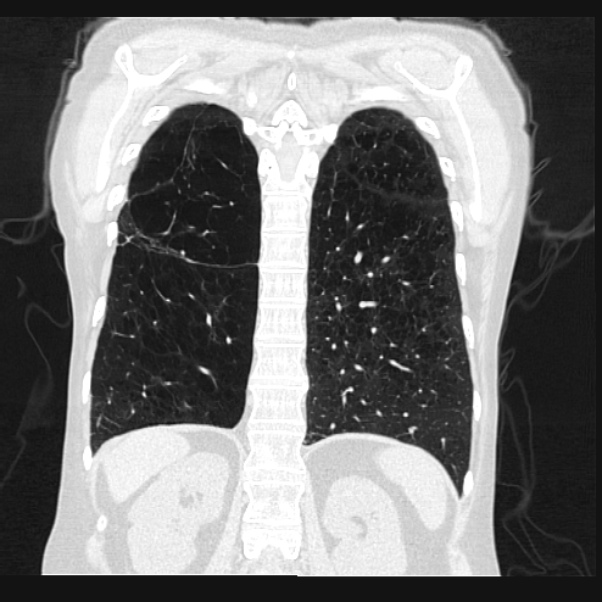 Centrilobular pulmonary emphysema (Radiopaedia 24495-24789 Coronal lung window 58).jpg